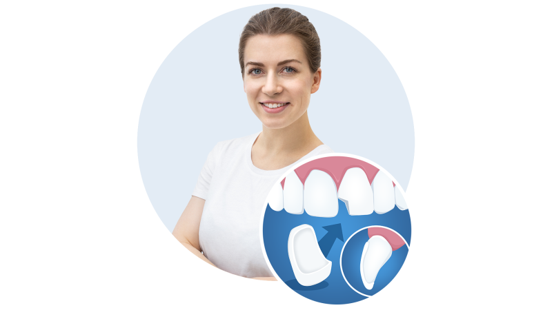 &nbsp;Laminaat&nbsp;(portselankoorik, -kate) &ndash; &uuml;li&otilde;huke ja erakordselt t&auml;pne keraamiline esihammaste kate, mis liimitakse hamba v&auml;lispinnale kasutades selleks kaasaegset adhesiivtehnikat.&nbsp; Milline osa on laminaatidel kaasaegses esteetilises stomatoloogias?&nbsp; Esteetilise ravi osat&auml;htsus on kaasaegse &uuml;hiskonna arenguga m&auml;rgatavalt suurenenud. &nbsp;T&auml;na oleme sooritamas &bdquo;imesid&ldquo;, millega pakume r&otilde;&otilde;mu meie patsientidele, kuna meditsiinitehnika k&otilde;rgtehnoloogia ja uued stomatoloogilised materjalid on avanud uusi v&otilde;imalusi esteetilises hambaravis. Kaasaegne hambaravi propageerib &bdquo;m&auml;rkamatuid&ldquo; esteetilisi hammaste taastamisi koos maksimaalse hoolivusega s&auml;ilitada oma hamba tugevaid kudesid. L&auml;&auml;nemere Hambakliiniku spetsialistid teevad esteetilist ravi maailma k&otilde;rgtasemel ja kasutavad k&otilde;ige kaasaegsemat tehnikat ning ohutuid materjale. Lubage endale l&uuml;hidalt tutvustada &nbsp;kaasaegse esteetilise hambaravi v&otilde;imalusi. Loe rohkem 		laminaatidest